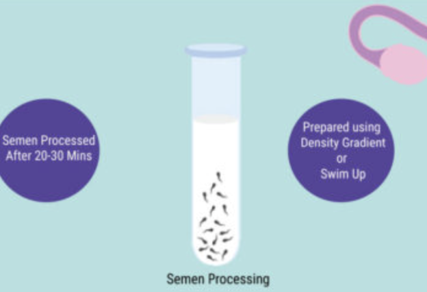 IUI Procedure at Zoi Fertility Clinic and the detailed steps